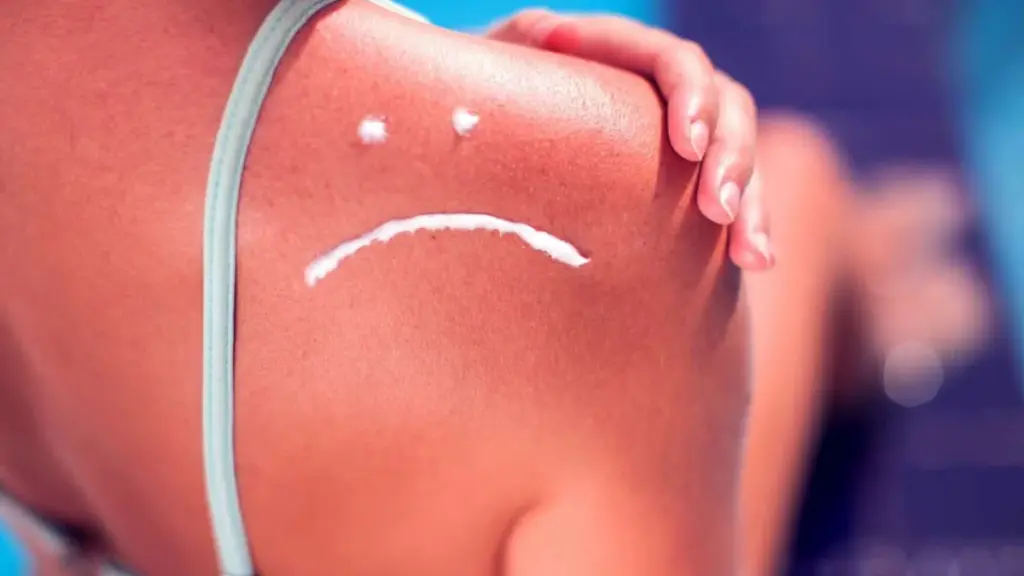 Remèdes Naturels pour Apaiser la Peau après un Coup de Soleil